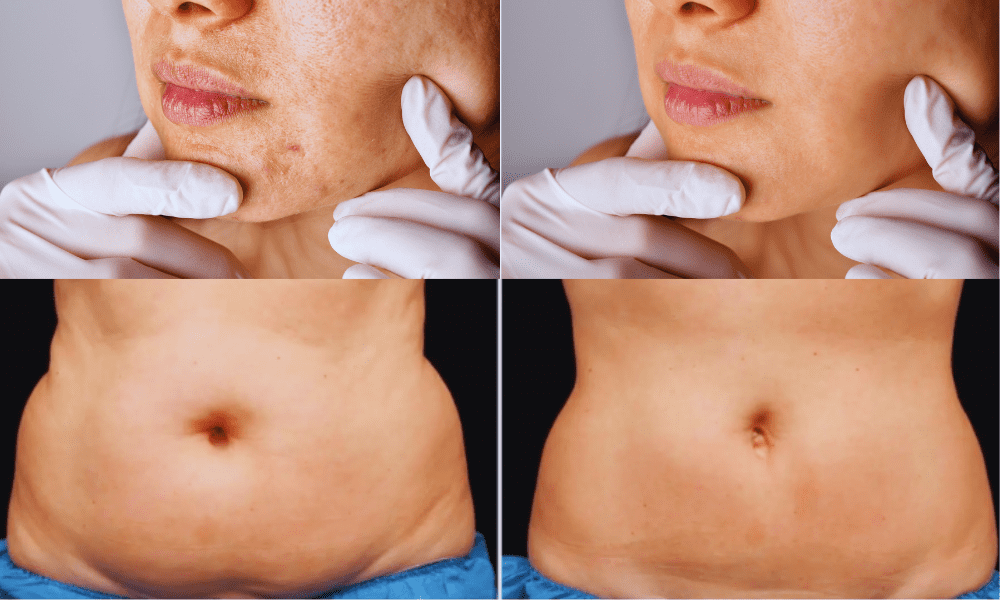 Formunuza Yeniden Şekil Verin: CoolSculpting ile Tanışın