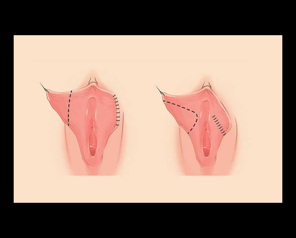 Labioplasti