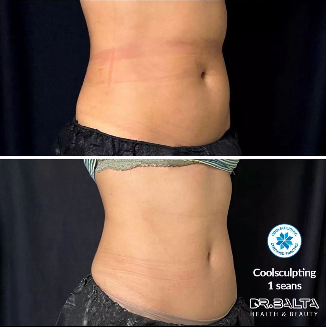 Coolsculpting (Soğuk Lipoliz)